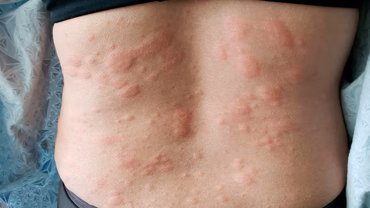 types-rashes-slide42