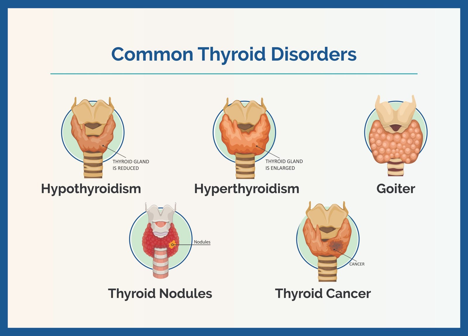understanding-thyroid-disorders02